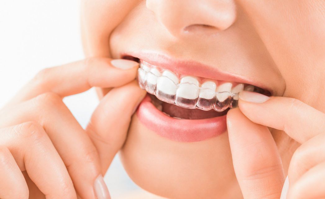 benefits-of-braces